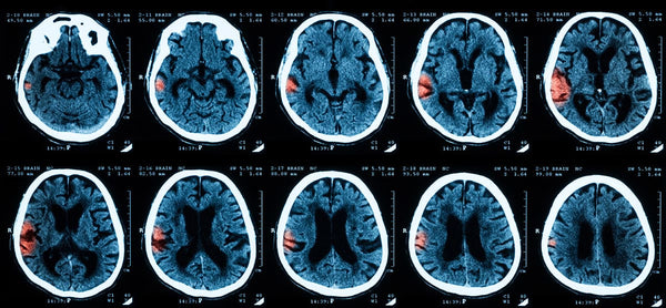 Catching TBI & PTSD Early, what are the signs in Veterans?