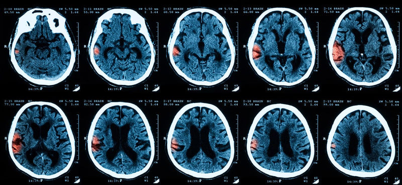 Catching TBI & PTSD Early, what are the signs in Veterans?